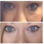 Tear-Trough Under Eye Treatment