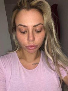 Holly Hagan prior to the CO2 Laser Facial