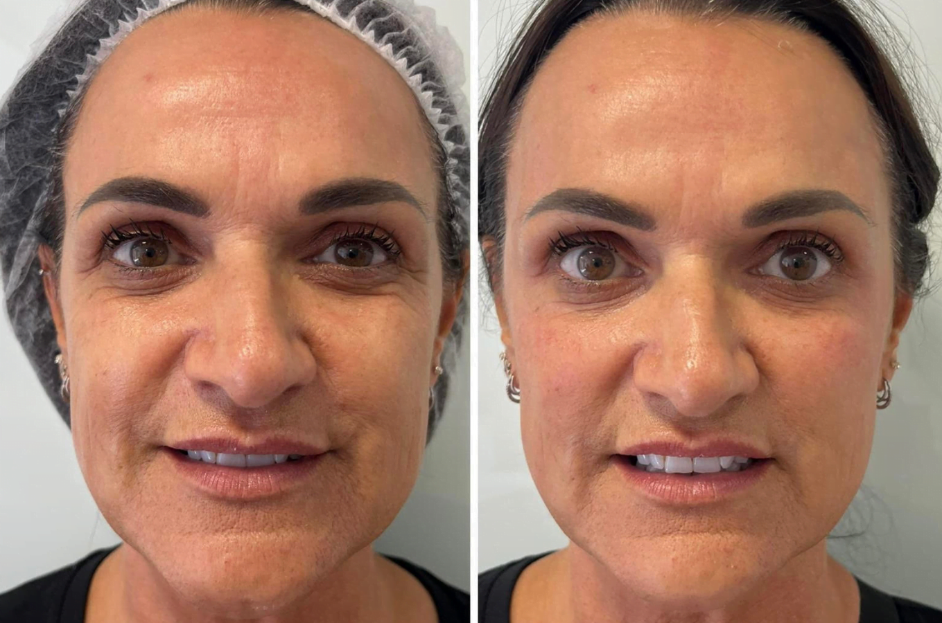 The Private Clinic Swansea - Dermal Fillers Before & After