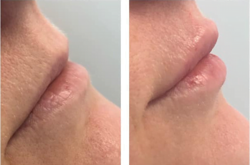 The Private Clinic Swansea- Lip Fillers Before and After