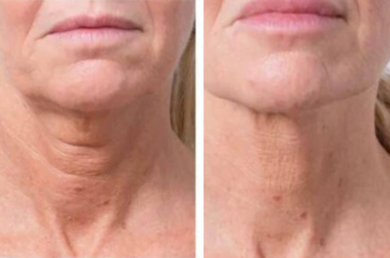 Profhilo Neck -Before & After Treatment