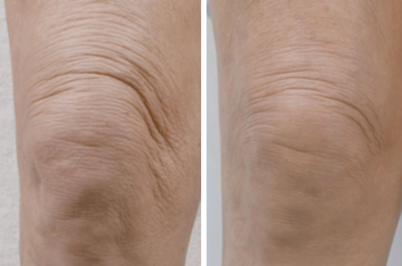 Profhilo - Before & After Knee