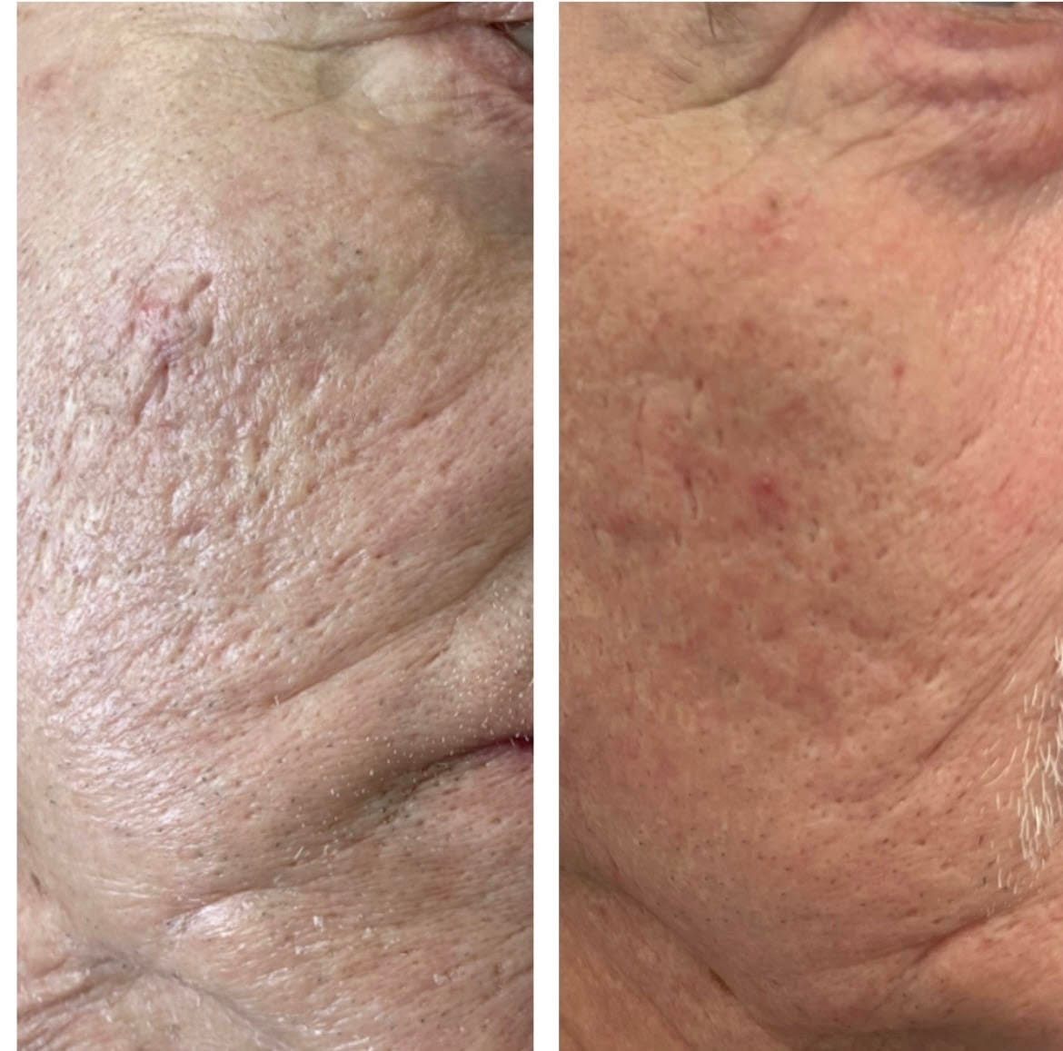 Co2 Laser Skin Resurfacing - Before and After - The Private Clinic Swansea
