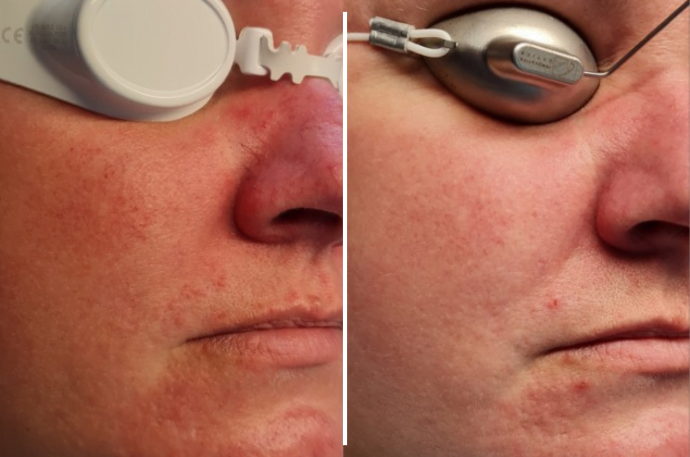 Laser Vascular - Before & After