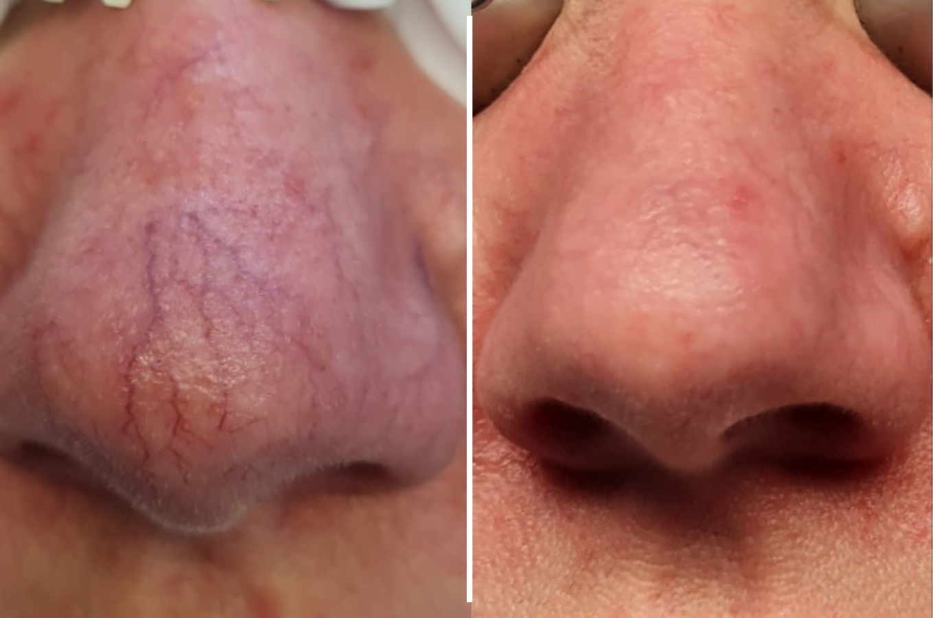 Laser Vascular - Before & After