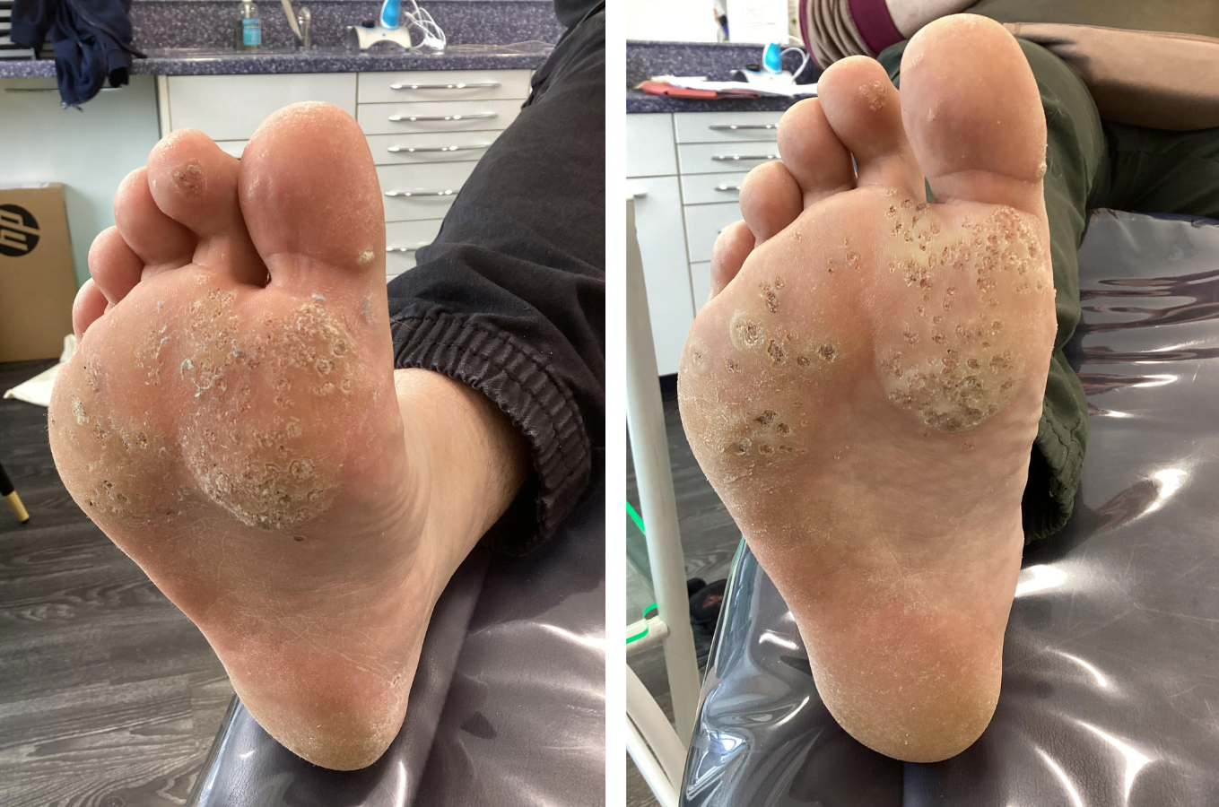 The Private Clinic Swansea - Before & After Wart and Verruca Removal