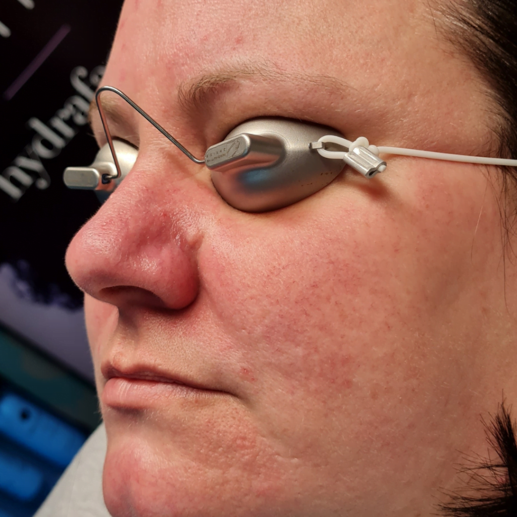 The Private Clinic Swansea - Laser Vascular