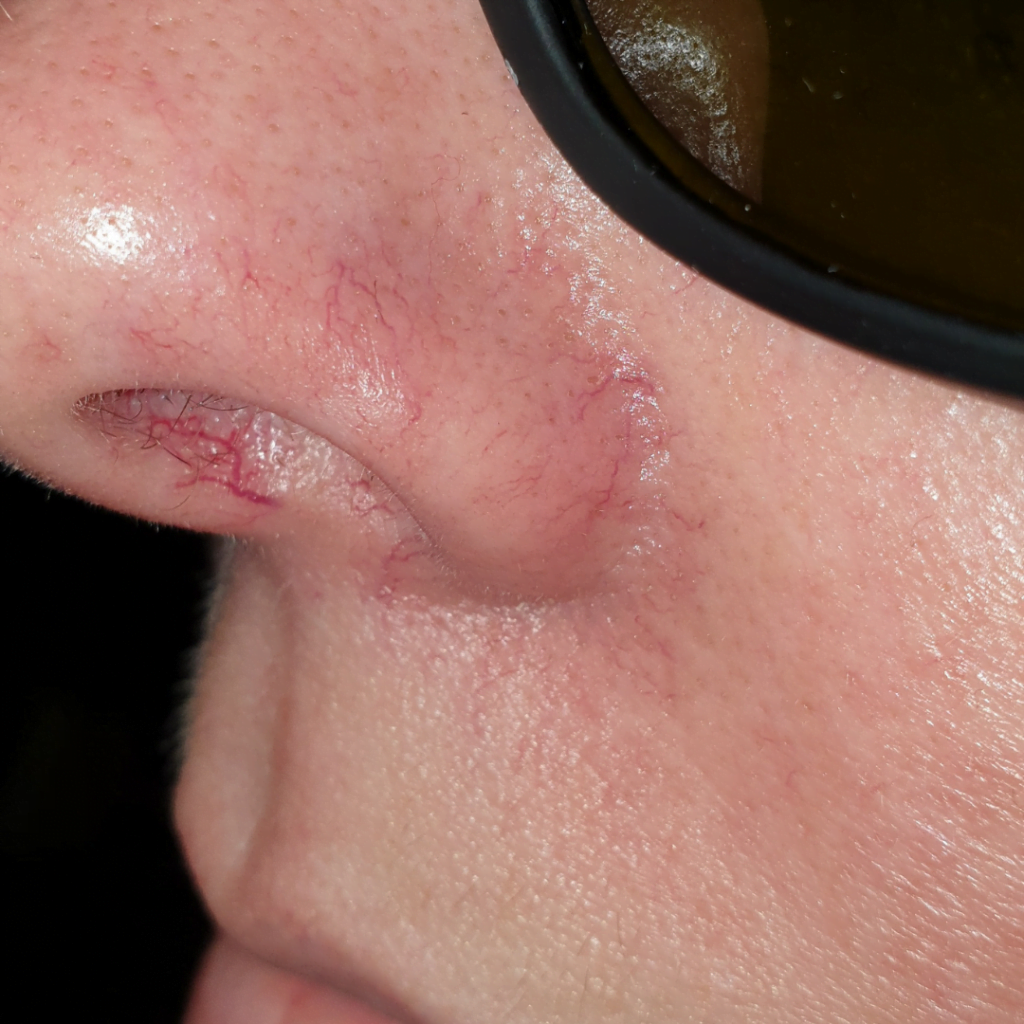 Laser Vascular - The Private Clinic Swansea