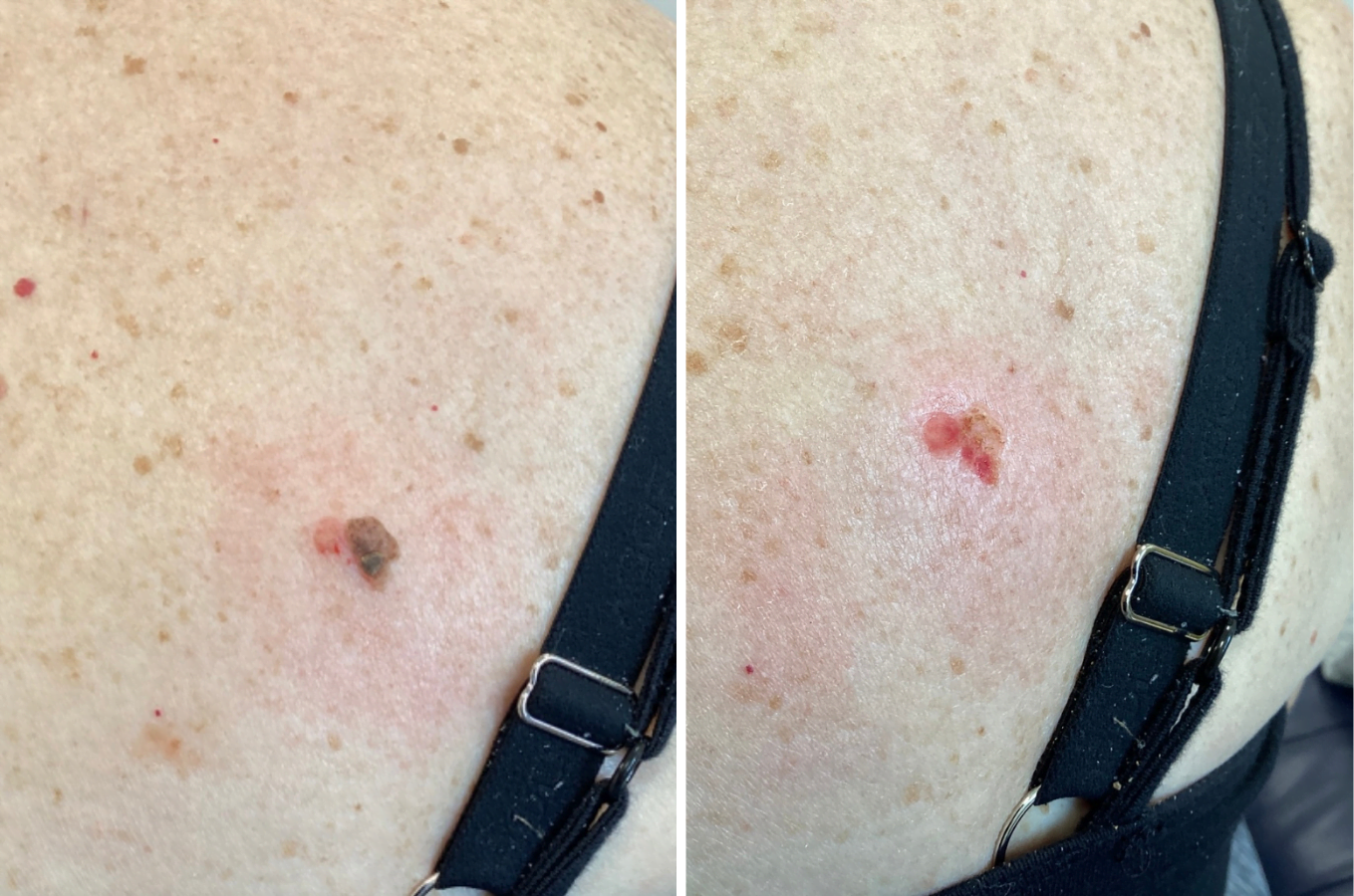 The Private Clinic Swansea - Before & After Lesion Removal