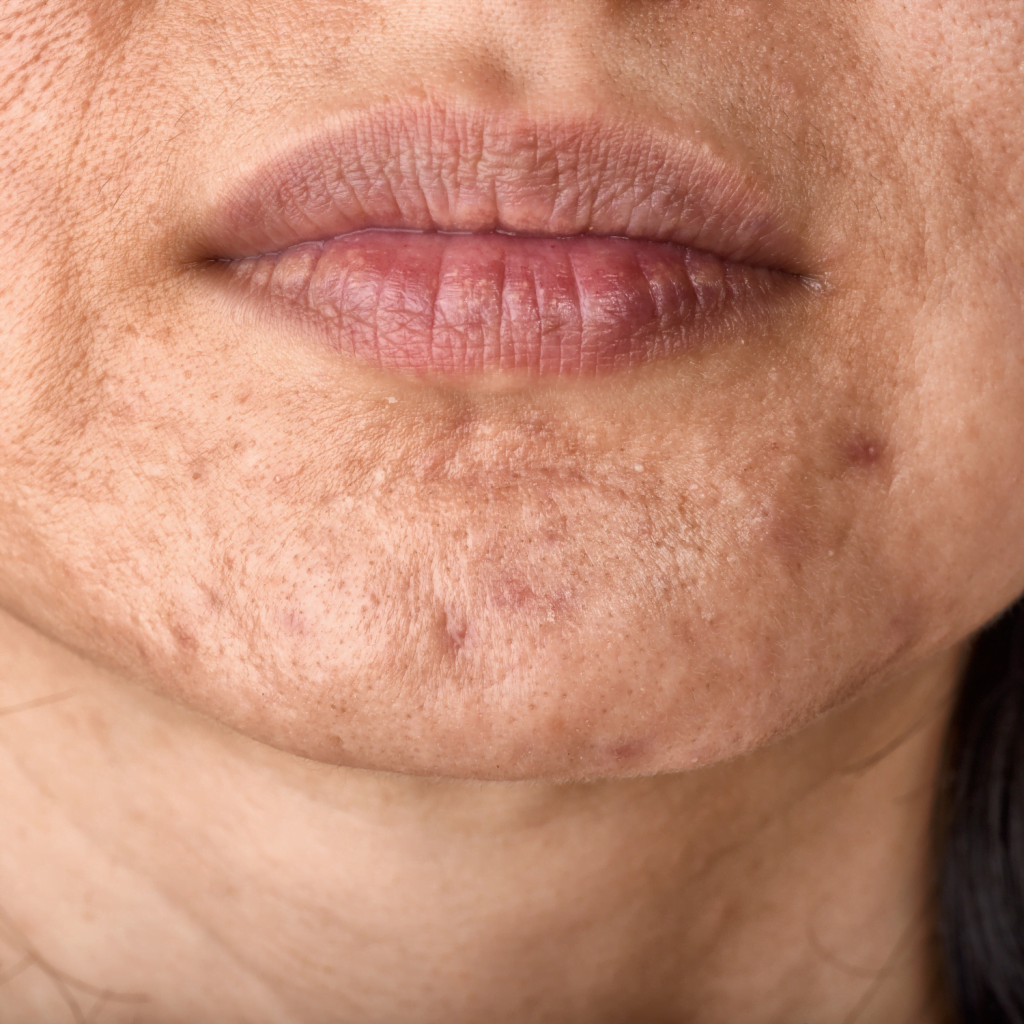 Scarring Treatments - The Grove Skin & Laser clinic