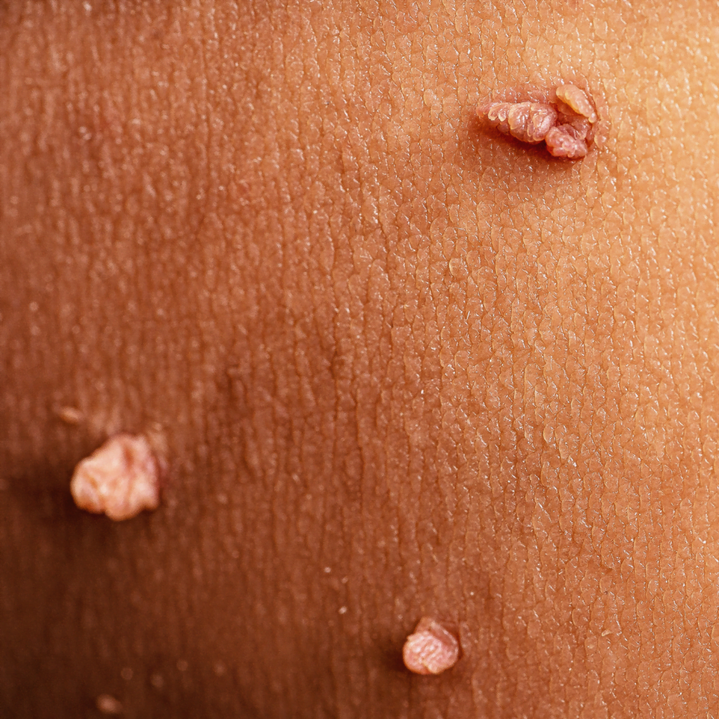 Skin Lesion Treatments - The Private Clinic Swansea