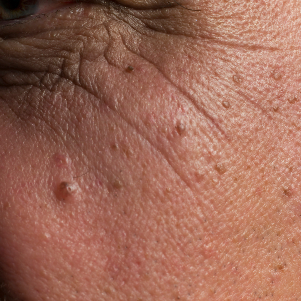 Age Spots - The Private Clinic Swansea