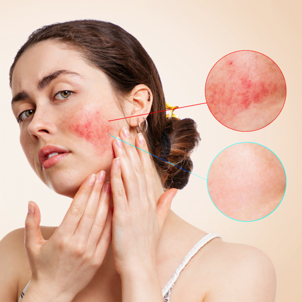 Rosacea Treatment - The Private Clinic Swansea