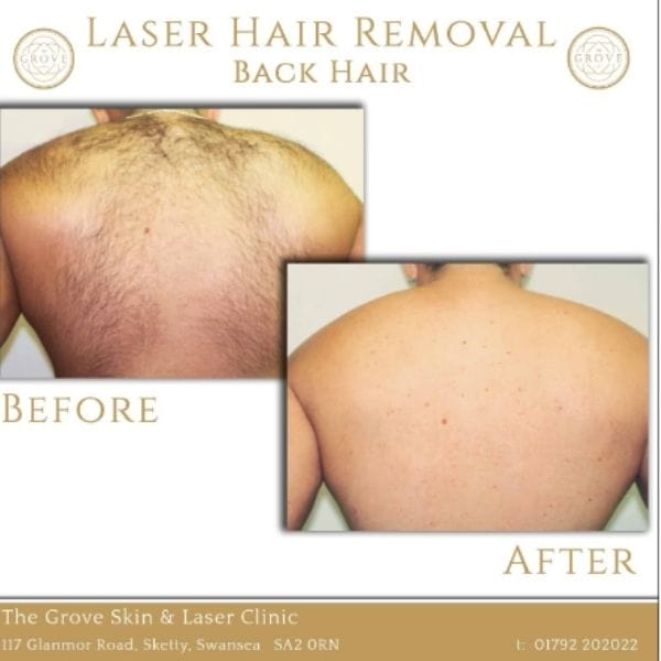 laser hair removal on back before and after
