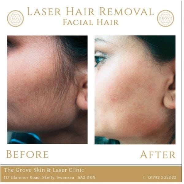 before and after facial laser hair removal