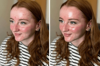 hydrafacial before and after