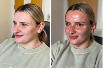 before and after hydrafacial the grove skin and laser clinic